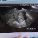 선인약국 | 첫 번째 임신 그리고 유산(배테기, 임테기, 첫 초음파, 임산부등록, 국민행복카드, 6주차 소파술)