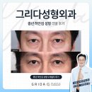 전의의원 | 하안검 수술로 되찾는 10년 전의 생기 있는 눈매