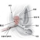 전립선 초음파 검사 [Prostate ultrasonography] 이미지