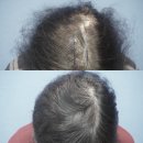 모아만의원 | 비절개 4300모 가격(비용), 이것만은 꼭 확인하세요