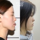 성인도 주걱턱교정 받아야 하는 6가지 이유