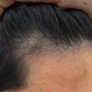 자혜로 | 부산 탈모병원 망미동 자혜병원 탈모약 복용 3개월 후기
