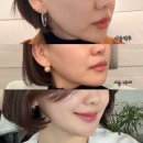 리프업의원 | 청담피부과의원 티타늄리프팅 3주차 후기, 얼굴 전후 비교사진 및 유지기간 정리