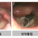 코 블랙헤드 제거 어렵다면? 가시털정체증 (소극성속모증) 의심! 이미지