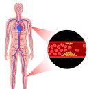 별다른 증상 없다 돌연사를 유발하는 다혈관질환 주의! 이미지