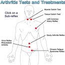 CRA arthritis test & treatments 이미지