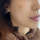 루카스 | 화곡역 피부과 흑자제거 루카스레이저 후기