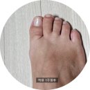 일등의료기 | 무지외반증교정기 추천 발가락교정기 PRO