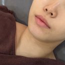 미본피부 | 부평 동암 피부관리 미본에스테틱 마이크로 바이오필 일주일 경과 솔직후기