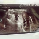 대하메디 | [난임]감눈 임신 후 과정&amp;졸업 및 감눈 솔직 후기(비추천)