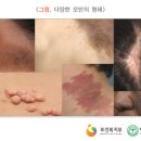 모반 nevus 이미지