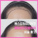 닥터공헤어라인의원 | 강남헤어라인모발이식 밴스모자이너의원 2탄｜수술 과정, 통증 솔직 후기