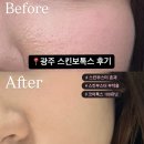 광주 성형외과 추천 | 광주 스킨보톡스 후기 및 부작용