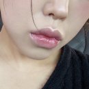대전 입술필러 후기 솔직한 체험 정리
