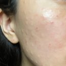 유한회사군산종합가스 | 밴스란힐러 내돈내산 리쥬란힐러 저렴이 통증 덜할까? (엠보/성분/붓기)