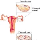 다낭성 난소증후군이라는데 ,왜 생기고, 언제까지 지속되는가? 이미지