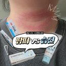 운동 후 목 피부가 빨갛게 변한다면? 땀띠 아닌 목 습진일 수도 (실제 치료 후기)