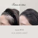 월드탑 | 인천두피페인팅 얼굴 작아보이는 헤어라인 예비신부관리 혜지오