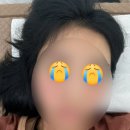 창문사 | 스테로이드쓰다 골로 갈거같아서 가본 바른샘한의원 한달후기
