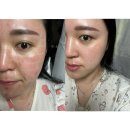 울트라짐 | 광주피부과 울트라클리어후기 효과, 케어, 통증 솔직후기