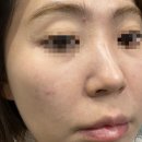 진균성모낭염? 지루성피부염? 주사피부염? 여드름? 이소티논? 이소티논한달후기? 이소티논 부작용? 뭔데?)