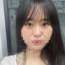 굳건병원 | [강남 줄기세포치료 피부과] 여자 정수리와 m자 탈모 PRF 내돈내산 후기 (미녹시딜 보다 낫다!)