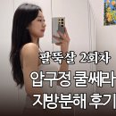 쿨 | 압구정지방분해 시술 2회차 후기｜쿨쎄라 + BB주사로 셀룰라이트 정리 후기