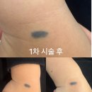 네오더퍼스트 | [부산/화명] 더퍼스트피부과 이소성몽고반점 레이저시술 후기