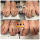 세니떼뷰티샵인후 | 웅포 수많은 발 관리샵 중 왜 '아이슈네일 & 풋더핸즈'를 선택할까요? 문제성 발 관리의 기준