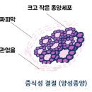 베데스다의원 | 갑상선 결절 세침검사했는데 4단계 여포성 종양이 나왔다면? 벌써부터 너무 걱정 마세요