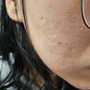 다시;봄한의원 | [내돈내산] 홍대여드름흉터 | 사월의 봄 한의원 | 새살침 | 1회 체험 후기