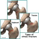 고관절 MRI (Hip MRI) 영상진단 이미지
