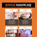 호박치과의원 네이버블로그