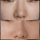 고랑포길 | 연예인 피부과에서 눈가주름시술 받은 후기 아이써마지 효과 가격 공유