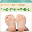 티눈일까 사마귀일까? 육안으로 구별하기 힘들 때는? 이미지