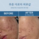 서강로 | 광주 여드름 피부관리 전문 | 푸른 아로마 피부샵 5회차 후기