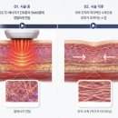 마스터성형외과의원 | 부산 올타이트 리프팅 가격? 40대 초기 노화라면 더 주목해야 하는 이유