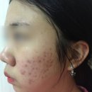 제일한의원 | 리유한의원 신사점 여드름 흉터 색소침착 가격 내돈내산 치료 후기