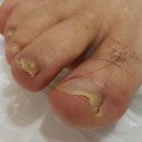 나도손톱 레푸스 개봉점 이미지