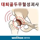 고관절통증은 대퇴골두무혈성괴사가 원인입니다 이미지