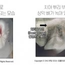 잇몸 아플 때, 치근단 농양 & 치근단 절제술 (치아뿌리 염증 통증 잇몸 고름 주머니) 이미지