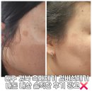 제2경북약국 | 대구경북 흑자 제거 피부관리 내돈내산 솔직 후기(비용, 시술 전후 사진 공개)