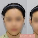 모자이크성형외과의원 | 접힌귀수술 (누운귀) 후기만으로 병원 결정하지마세요