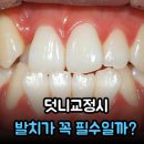 (주)케이엠교정덴탈 | 공간이 부족한 덧니는 교정할 때 발치가 꼭 필수일까? | 미아역근처치과