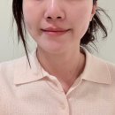 시청역 | [후기] 시청역 을지로 피부과 티타늄리프팅 효과 가격