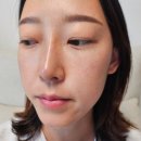 에이에프피식물병원 주식회사 | 시카 엑소좀 세렉소(Celexo) 스킨부스터 시술 체험