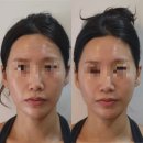 가락한의원 | 강남안면비대칭 관리 한의원 솔직 후기