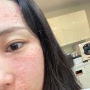 한나동물병원 | Wedding record, 예비신부 시술 팔자주름 필러, 리쥬란힐러, 리프테라 리프팅 내돈내산 후기