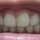 미르교정치과기공소 | 구미 미르치과 교정!!! 5년 후!!! 후기