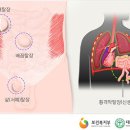 명지항외과의원 | 탈장 수술 후 회복 기간과 관리, 간호 방법